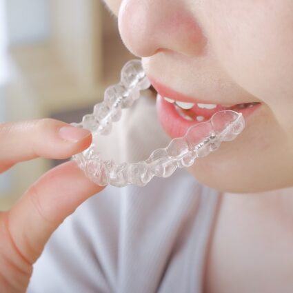 マウスピース型アライナー