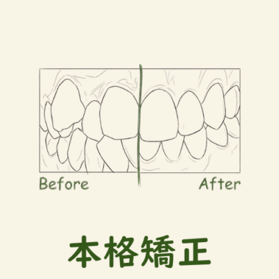インビザライン矯正