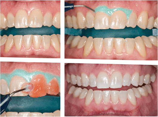 オフィスホワイトニング_説明画像