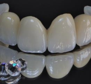 ジルコニアレイヤリングブリッジ