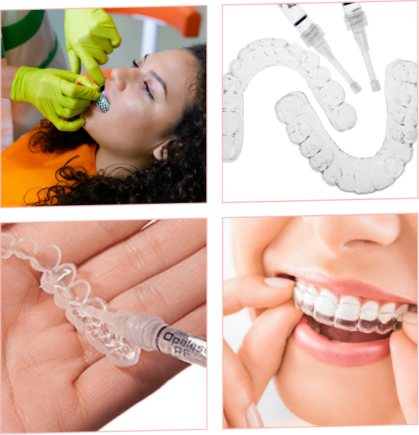 ホームホワイトニング 説明画像